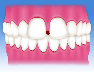 空隙歯列弓、すきっ歯